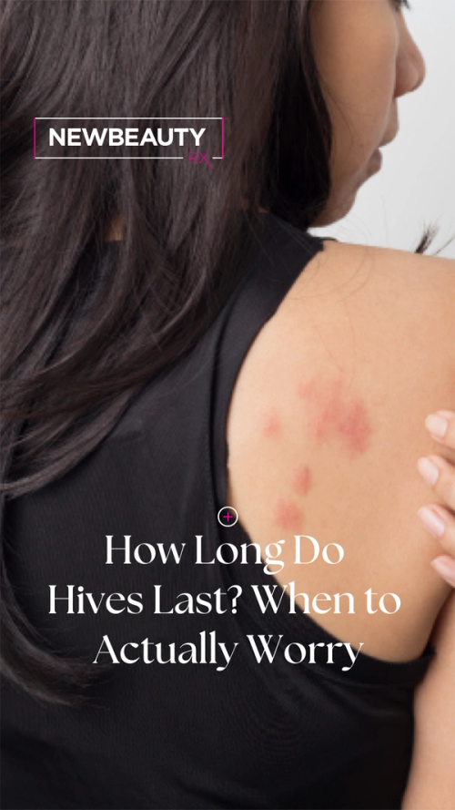 Dr. Payvand Kamrani Breaks Down Chronic Hives