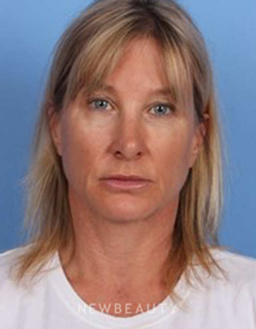Dr. Kelly Bomer - Anti-Aging - Before
