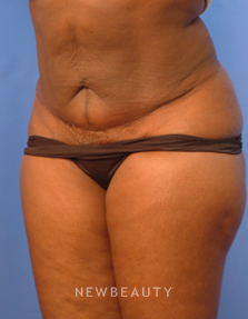 Dr. Peter Geldner Mini Abdominoplasty with Vaser Liposuction - After