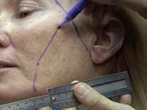 Dr. Jacono – Wide Awake Short Incision Mini Face Lift