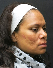 Dr. Jody Levine- Lasers - Before