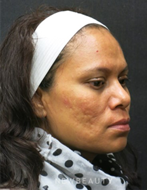 Dr. Jody Levine- Lasers - Before