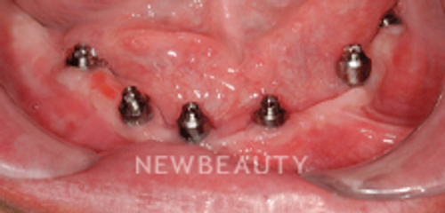 Dr. Hamid Atabakhsh - Dental Implants - 46426474 - Before