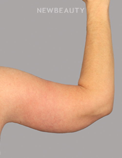 Dr. Mahabir - Arm Lift - 20638033 - After