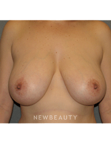 Dr Sean Simon Breast Augmentation - Before