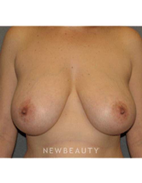 Dr Sean Simon Breast Augmentation - Before