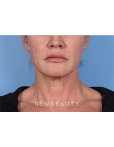 Dr. Kelly Bomer - Chemical Peels - After