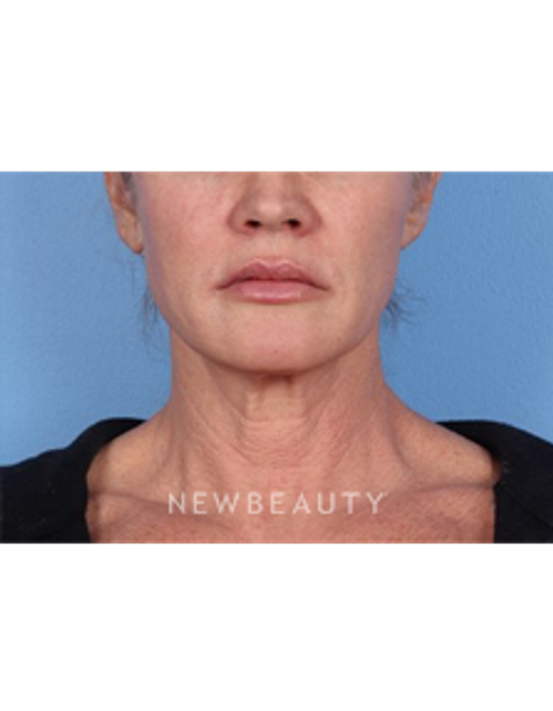 Dr. Kelly Bomer - Chemical Peels - After