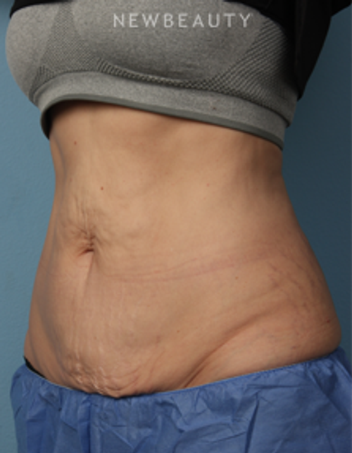 Dr. Kathleen Behr - Emsculpt - After