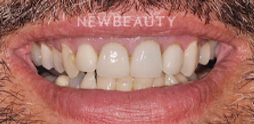 Dr. Salvator La Mastra - Smile Makeover -46106635 - Before