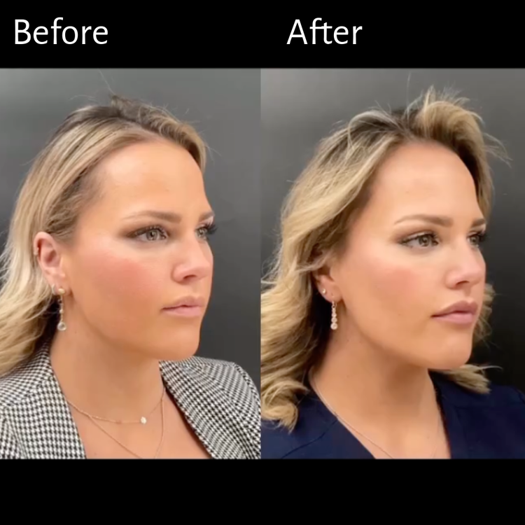 Lower-Face Revival