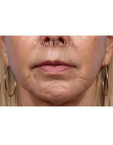 Dr. Kelly Bomer - Lips - Before