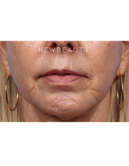 Dr. Kelly Bomer - Lips - Before