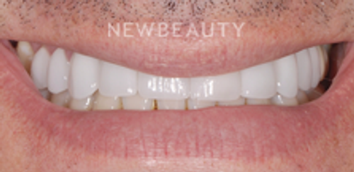 Dr. Salvator La Mastra - Smile Makeover -46107833 - After