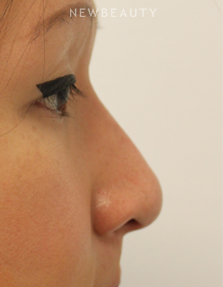 Dr. Kimberly Lee - Non-Surgical Rhinoplasty - After