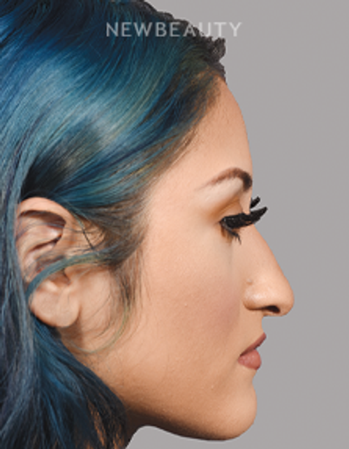 Sam P Most, MD - 21009796 - Rhinoplasty - Before
