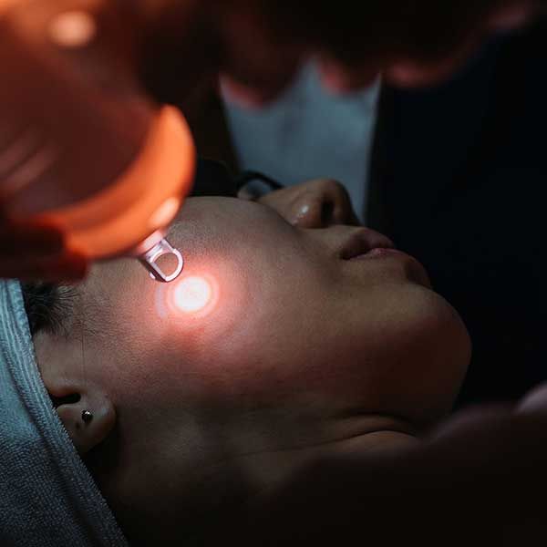 Best Laser Treatment for Acne
