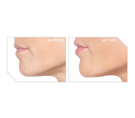 Before and after chin filler