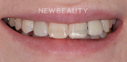 Dr. Salvator La Mastra – Smile Makeover – 46107174 - Before