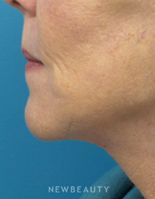 Dr. Christine Hamori - Facelift - After