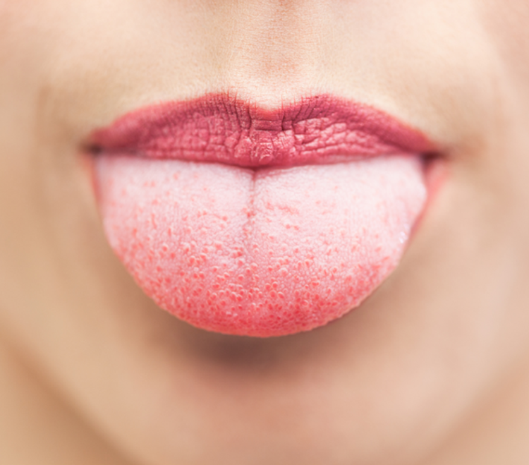 Dry Mouth 