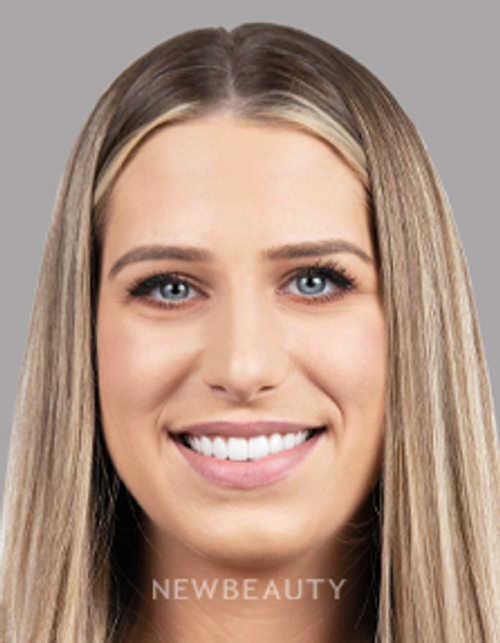 Dr. Nathan Hoffman - Smile Makeover - After