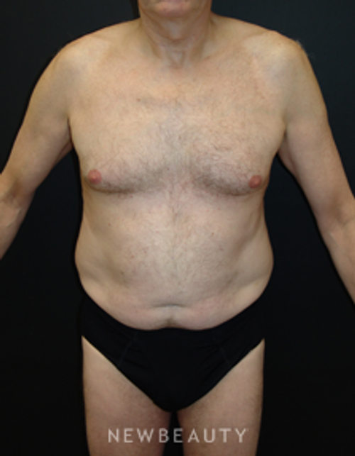 Dr. Mokhtar Asaadi Liposuction - Before