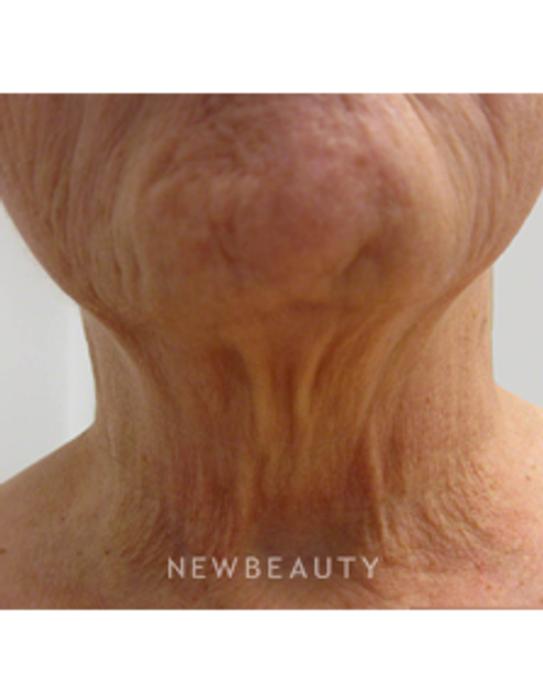 Dr. Kally Papantoniou - Ulthera - Before
