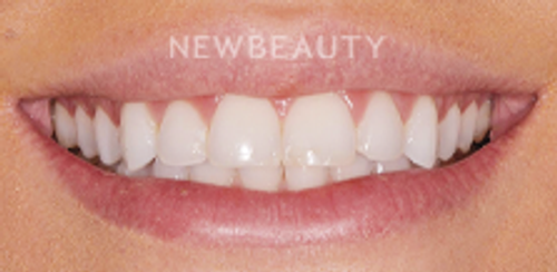 Dr. Salvator La Mastra - Smile Makeover -46106752 - Before