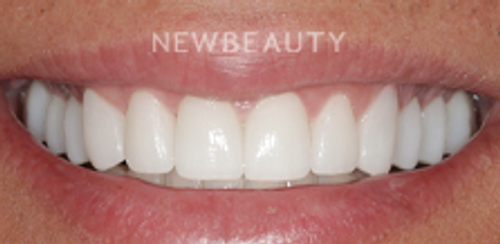 Dr. Salvator La Mastra - Smile Makeover -46106837 - After