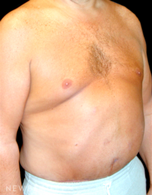 Dr Mokhtar Asaadi Liposuction, Male Plastic Surgery - After