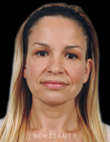 Dr. Kenneth Beer Injectables & Fillers - Before