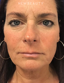 Dr. Dilip Madnani – Facelift & Necklift - Before