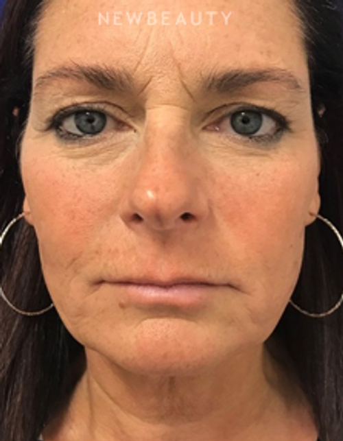 Dr. Dilip Madnani – Facelift & Necklift - Before