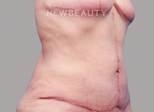 Dr. Michael Lofgren - Tummy Tuck After Weight Loss - 44688404 - After