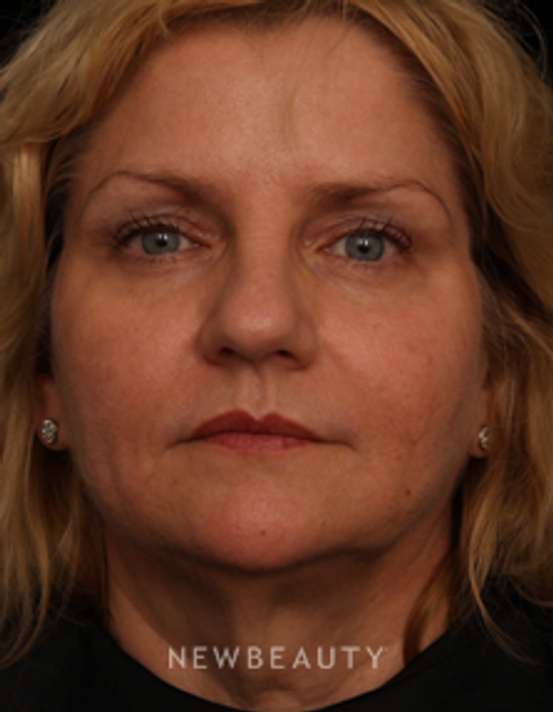 Dr. Jennifer M. Segal - Facial Rejuvenation - After