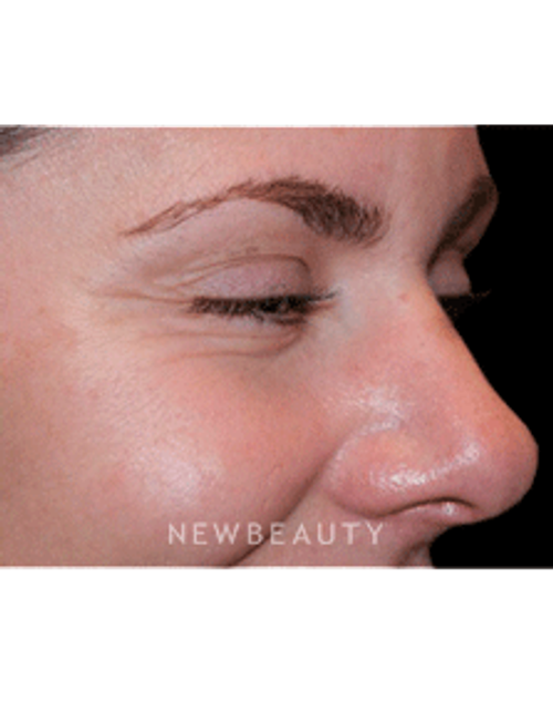 Dr. Marina Peredo Botox - Before
