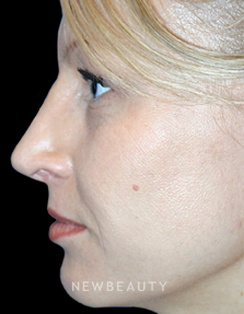 Dr. Kelly Bomer - Rhinoplasty - After
