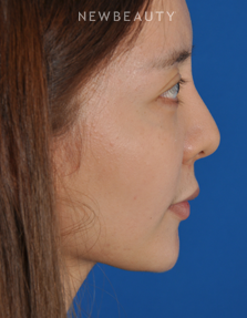 Dr. Edward Kwak - Revision Rhinoplasty - Before