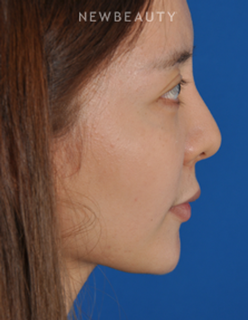 Dr. Edward Kwak - Revision Rhinoplasty - Before