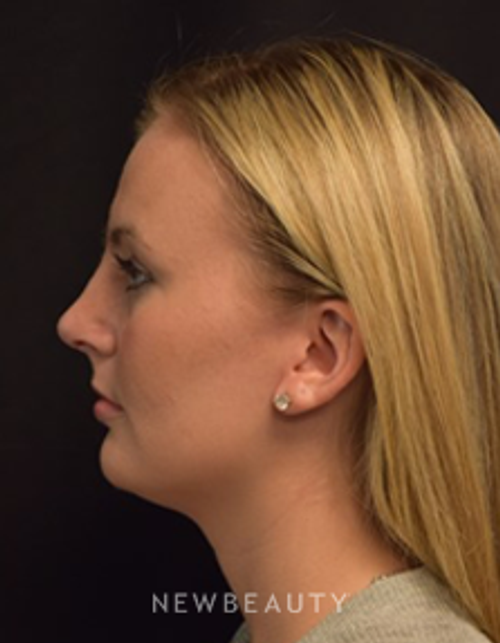 Dr. Jeffrey B. Wise - Rhinoplasty - After