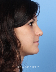 Dr. Kelly Bomer - Rhinoplasty - After