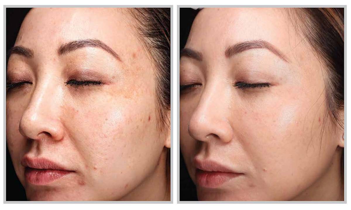 Before and after one HALO TRIBID session.