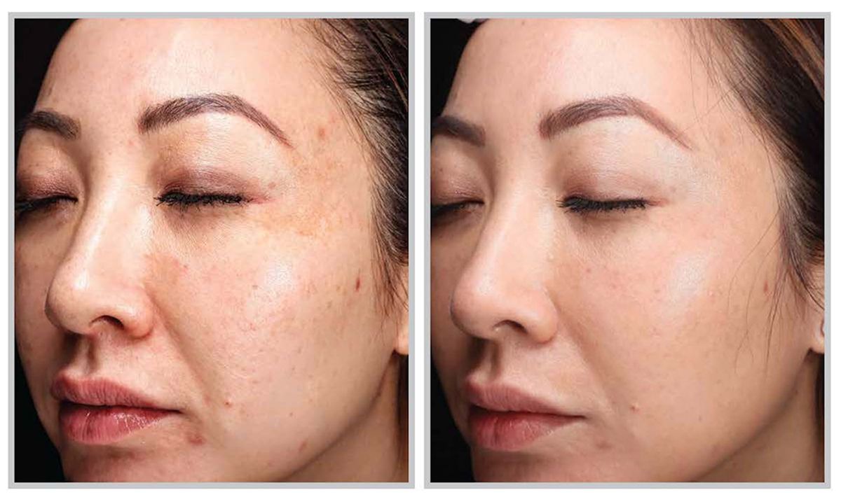 Before and after one HALO TRIBID session.