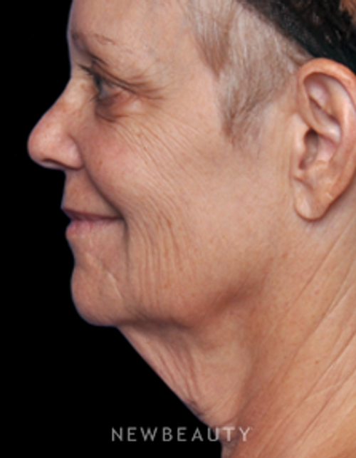 Dr. Alan Durkin - Limited Incision Facelift - Before