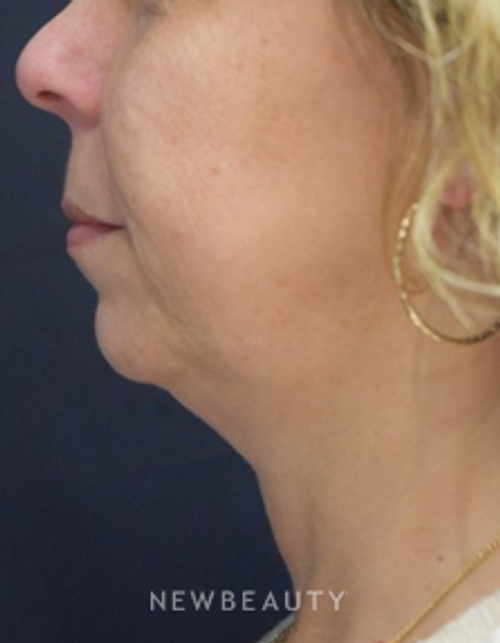 Dr. Jeffrey B. Wise - Ultherapy & Juvederm - Before