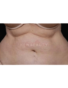 Dr. Ruth Hillelson Coolsculpting by Zeltiq - Before