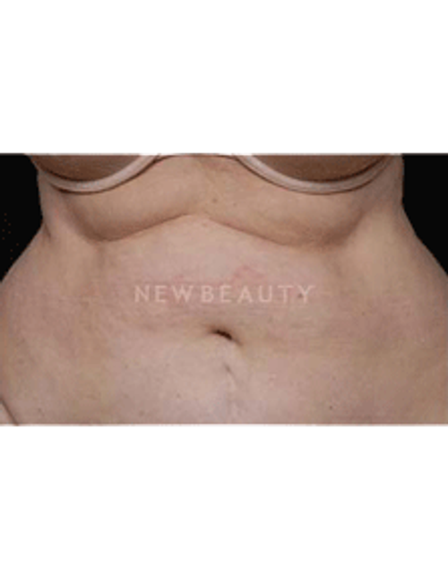 Dr. Ruth Hillelson Coolsculpting by Zeltiq - Before