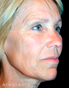 Dr. Kelly Bomer Facelift - Before