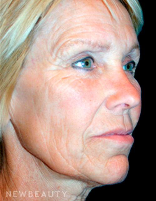 Dr. Kelly Bomer Facelift - Before